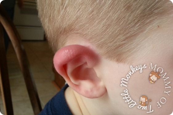 Red Swollen Ear Lobe - What Happened to His Ear!